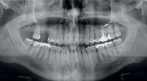 Stomatologie-Quiz: Freiliegender Knochen distal des Zahnes 17