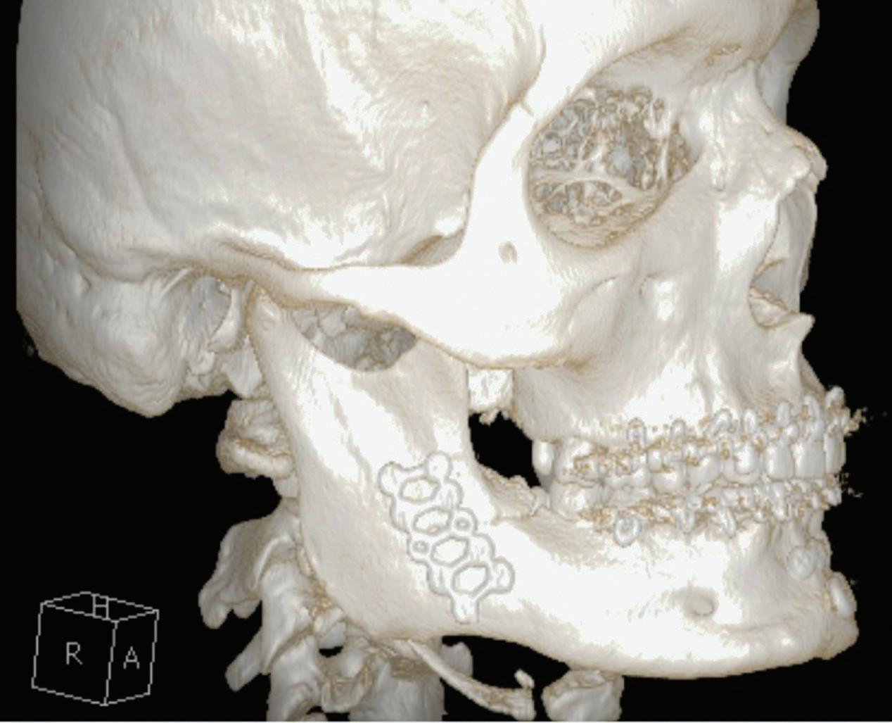 TRATAMENTO PARA Fratura Mandibular