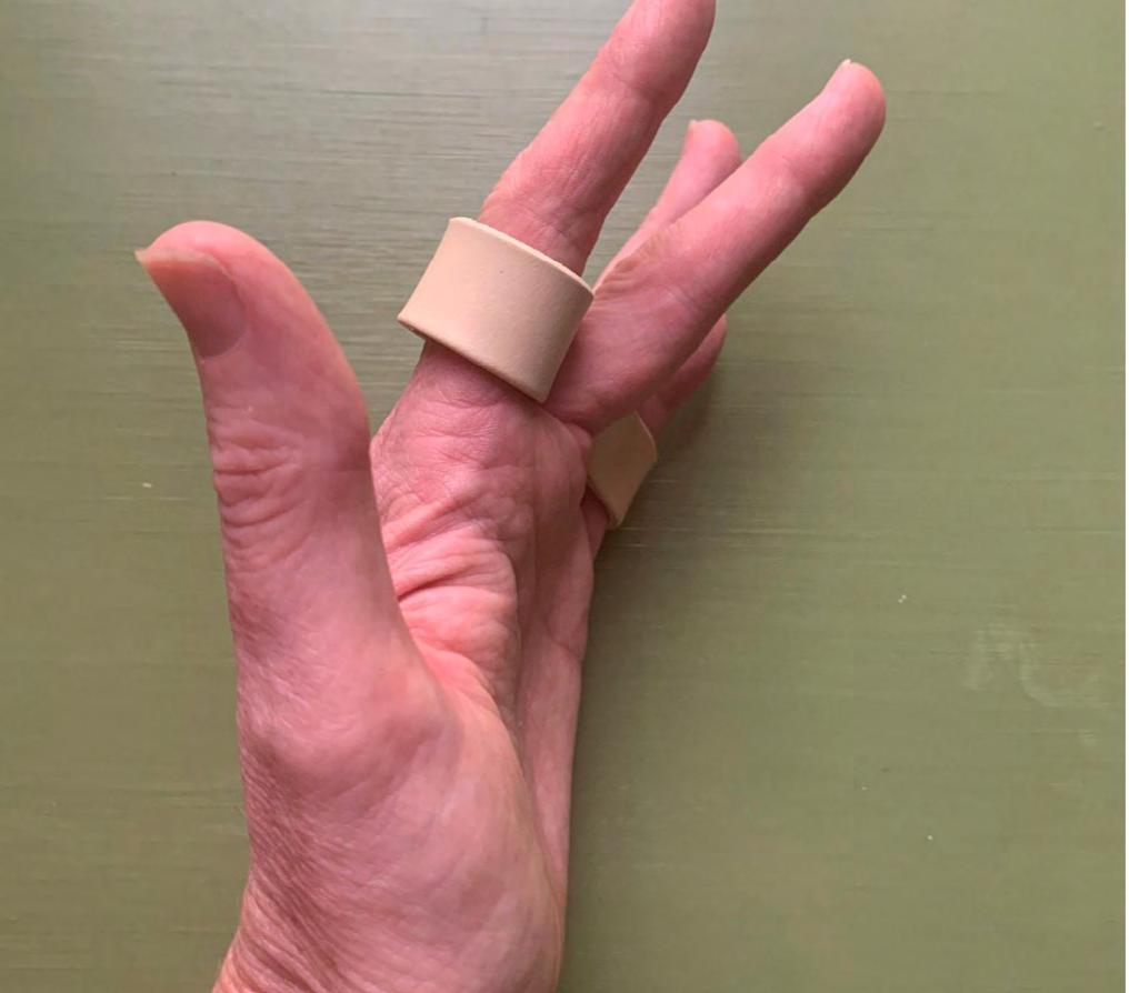 Relative motion flexion splints in the management of finger flexor