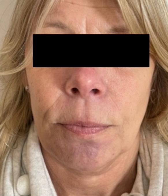 Case Study: Delayed Hypersensitivity Reaction - Issuu