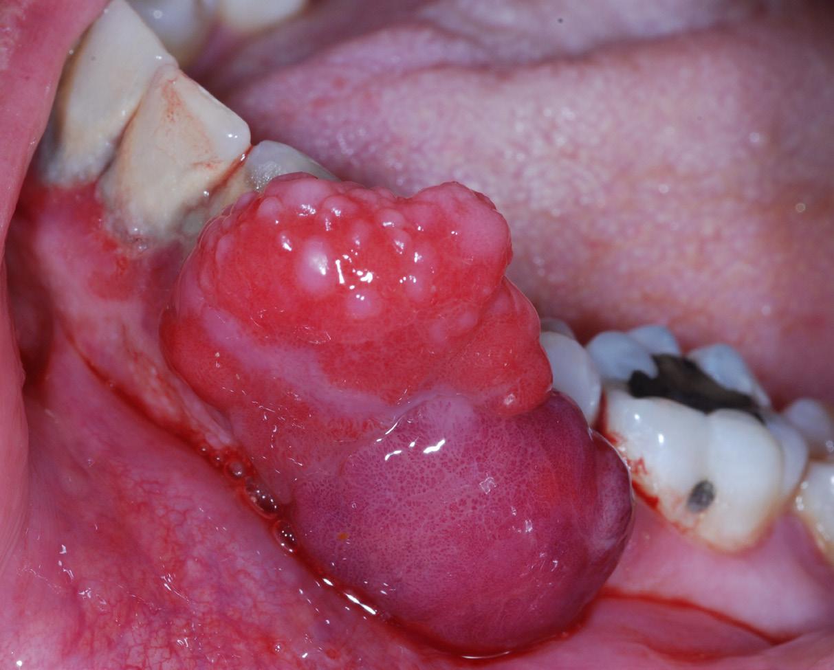 Differential Diagnosis: Solitary Gingival Mass - Issuu
