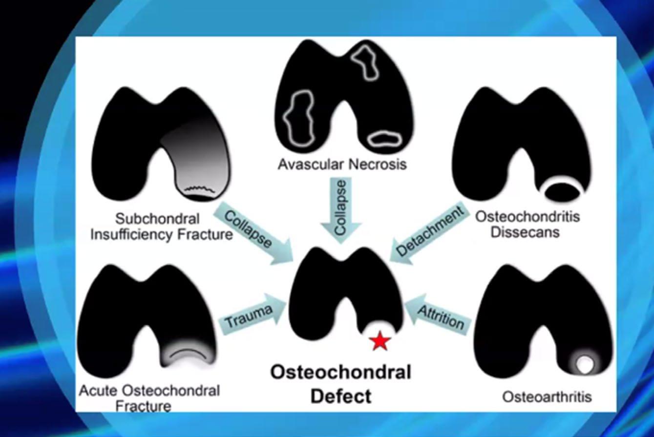 Focal Cartilage Defects and Osteochondral Lesions: Affect up to 15% of active individuals, often necessitating surgical repair or Cellular Therapy and Stem Cells for Dermatology and Skin Conditions to prevent osteoarthritis progression