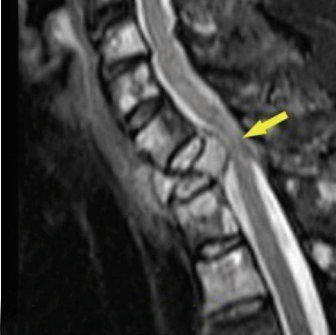 Multiple Myeloma-Causes-Symptoms-diagnosis-treatment-Homeopathic Treatment-best Homeopathic doctor- Dr Qaisar Ahmed-Al Haytham clinic-Risalpur-KPK-Pakistan