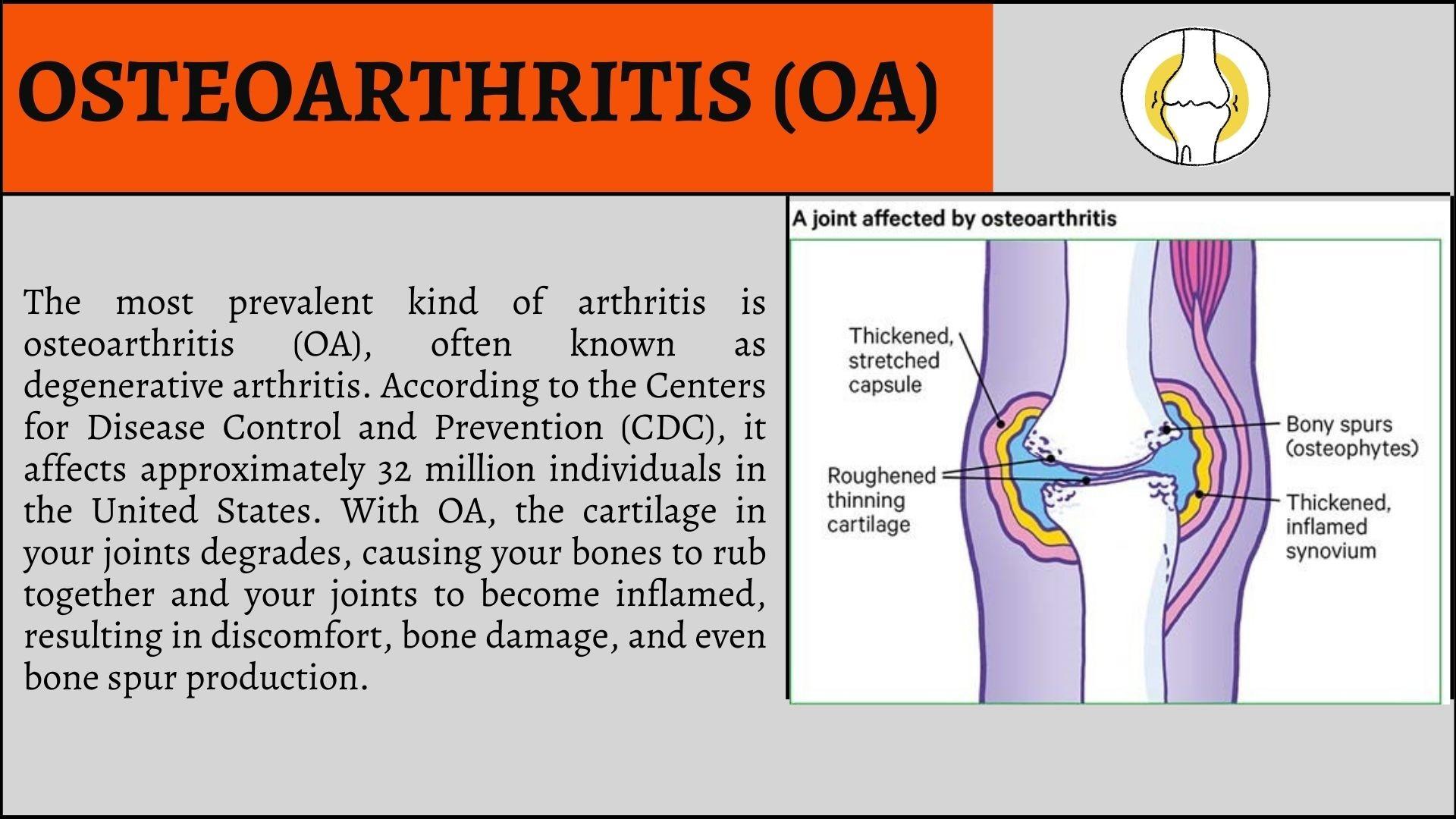 Types of Arthritis by Dr. David Shenassa, MD Issuu