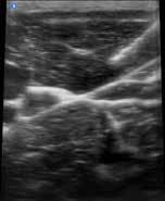 This image depicts the ultrasound-guided median nerve block. The needle
is approaching the nerve from the right and the nerve is the hyperechoicstructure in the center.