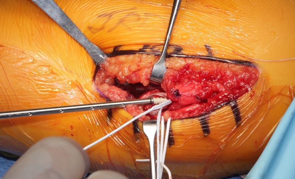 Inguinal Hernia Repair by Dr. David W. Ford