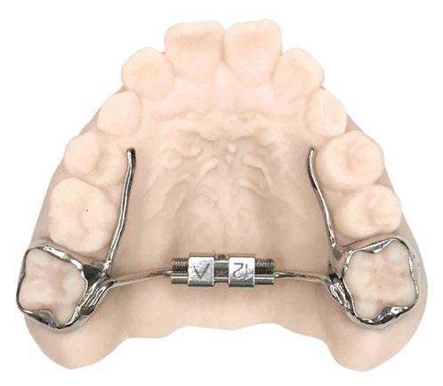 Tooth-borne (Hyrax ® ) Expander. 1 = Bands, 2 = Hyrax ® -screw