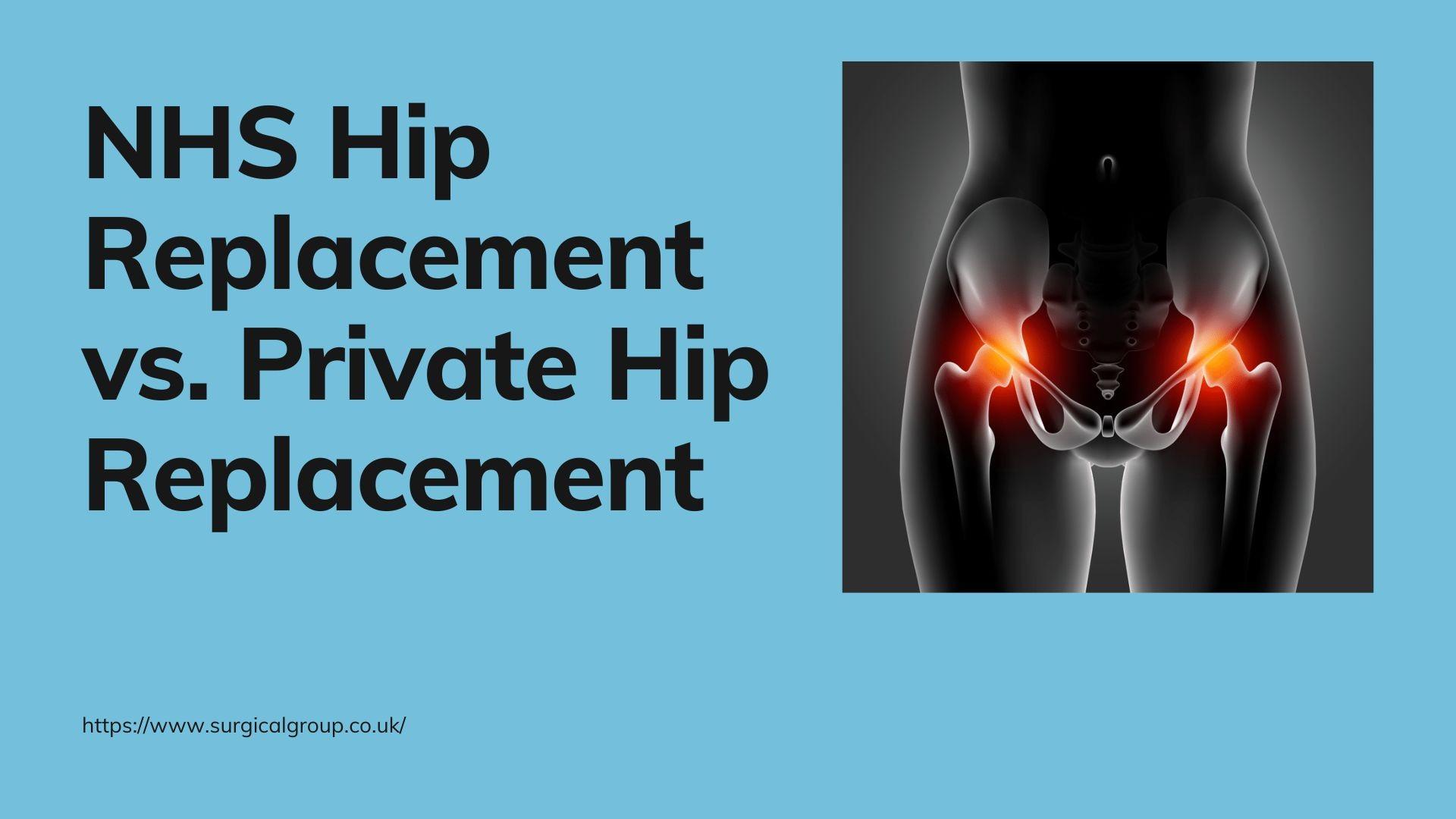 NHS Hip Replacement vs. Private Hip Replacement by Surgical Group Issuu