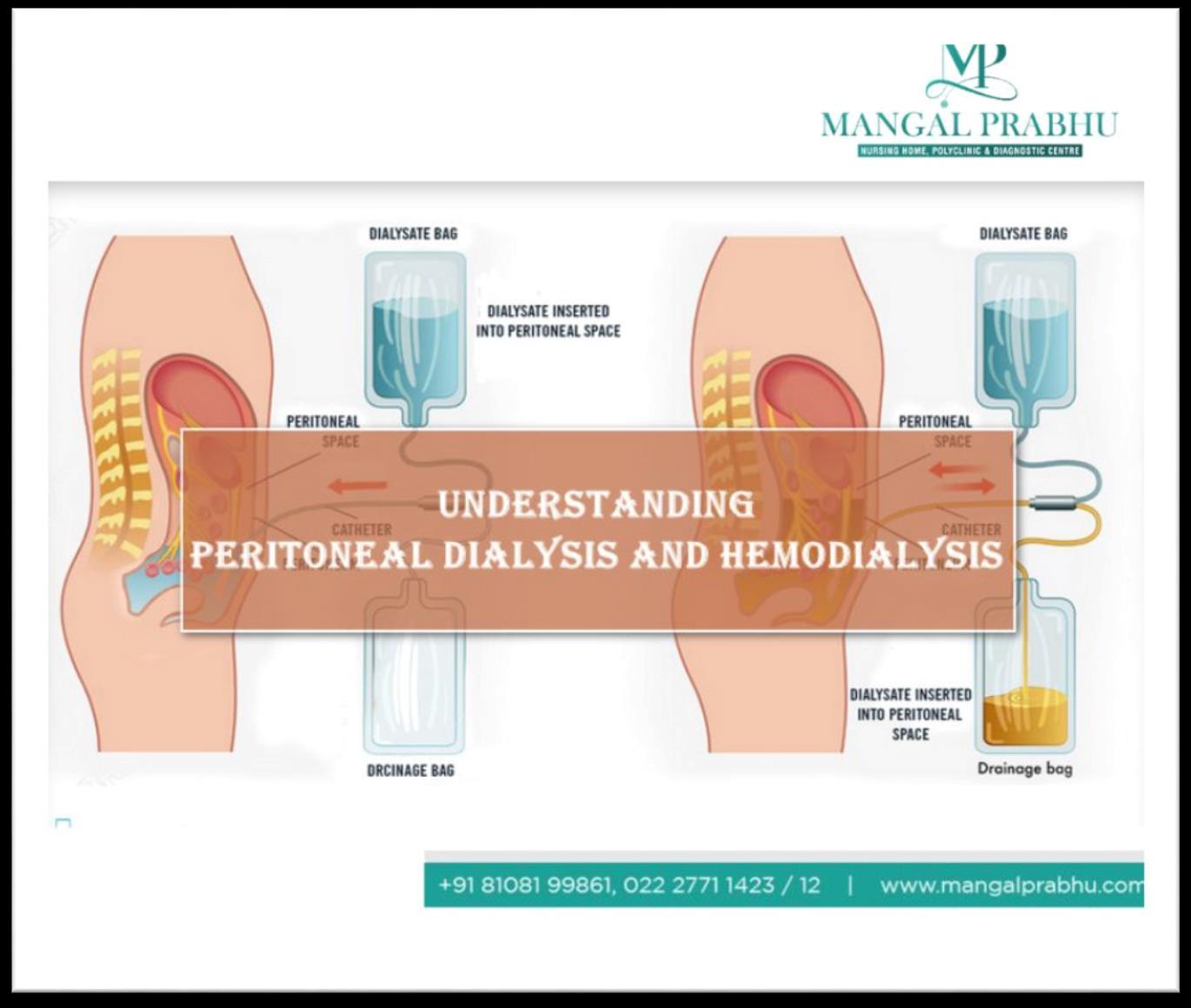 Do You Know Major Difference Between Hemodialysis and Dialysis? by