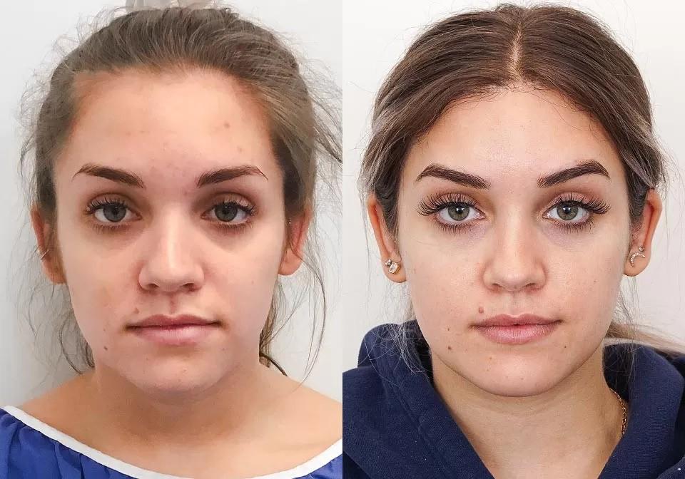What is Botox Eyebrow Lift & How Can It Make You Look Younger? by