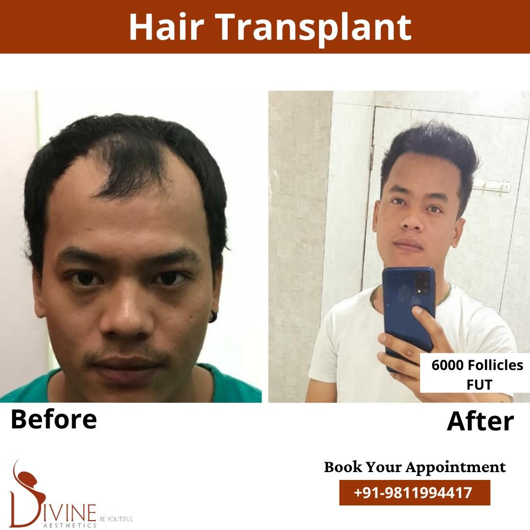 Do you think is there any side effects of Hair Transplant Surgery.pptx