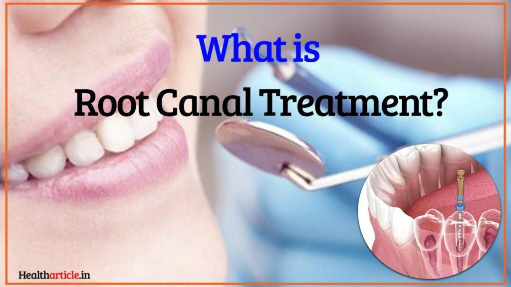 Root Canal Treatment Step by Step by drsmilez2018 Issuu