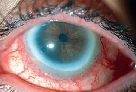 Cover for KEEPING THE OCULAR SURFACE HEALTHY IN THE GLAUCOMA PATIENT