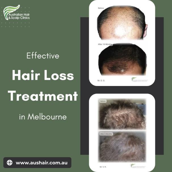 Early Hair Loss With Treatment From Australian Hair & Scalp