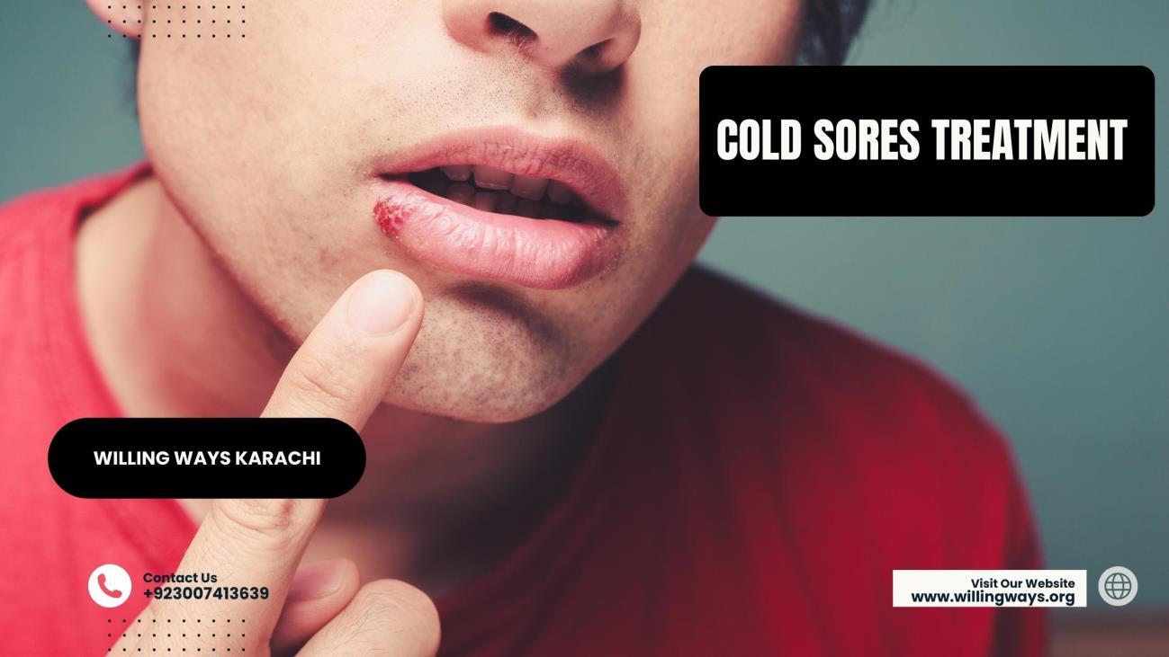 Cold Sores Treatment by willingwayskarachi Issuu