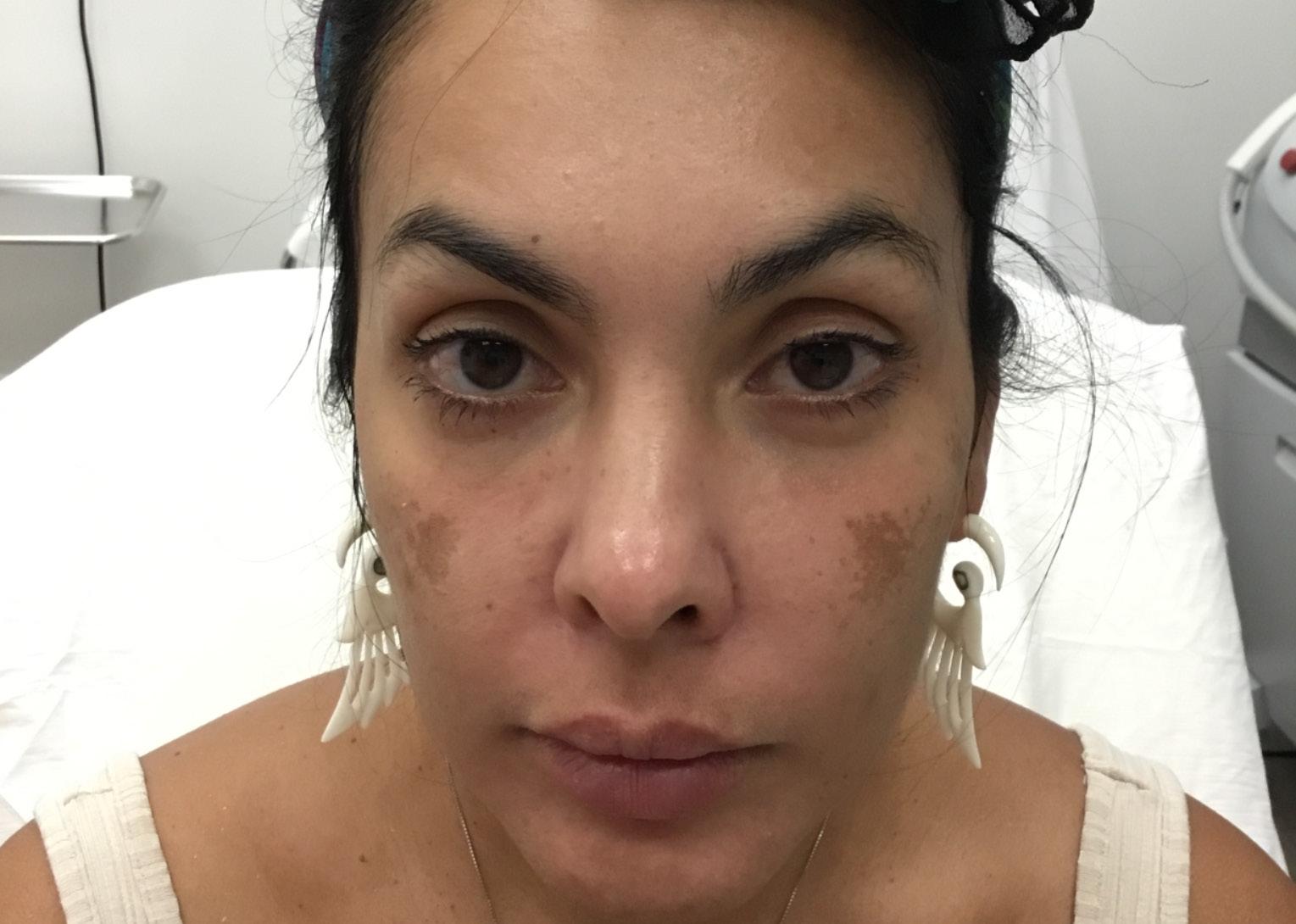 LaserAway Services Lookbook by LaserAway Issuu