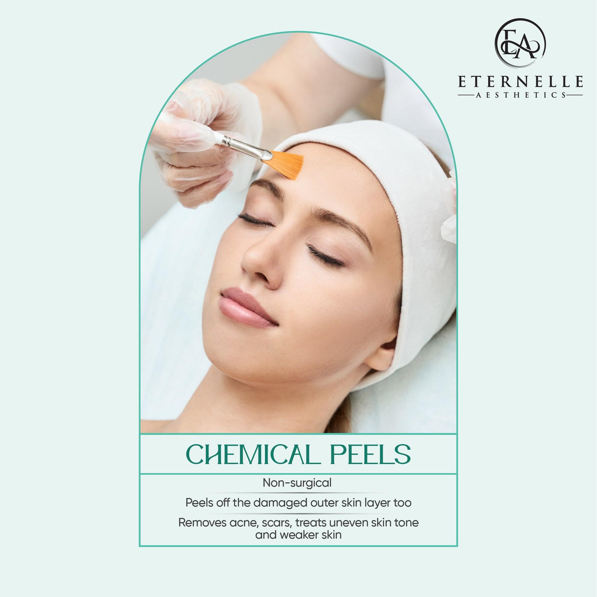 Chemical Peels for Acne Scars Removal of Acne Scars Acne Skin