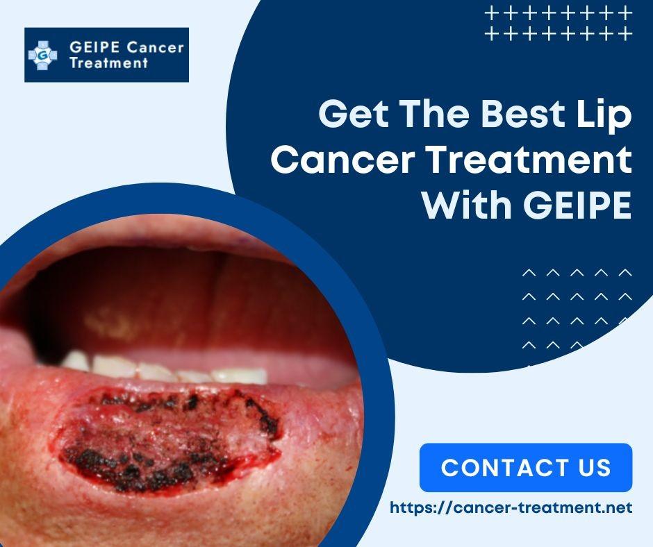 What Are The Causes And How To Treat Lip Cancer by GEIPE Cancer