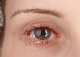 Microscopic Organisms On Eyelashes