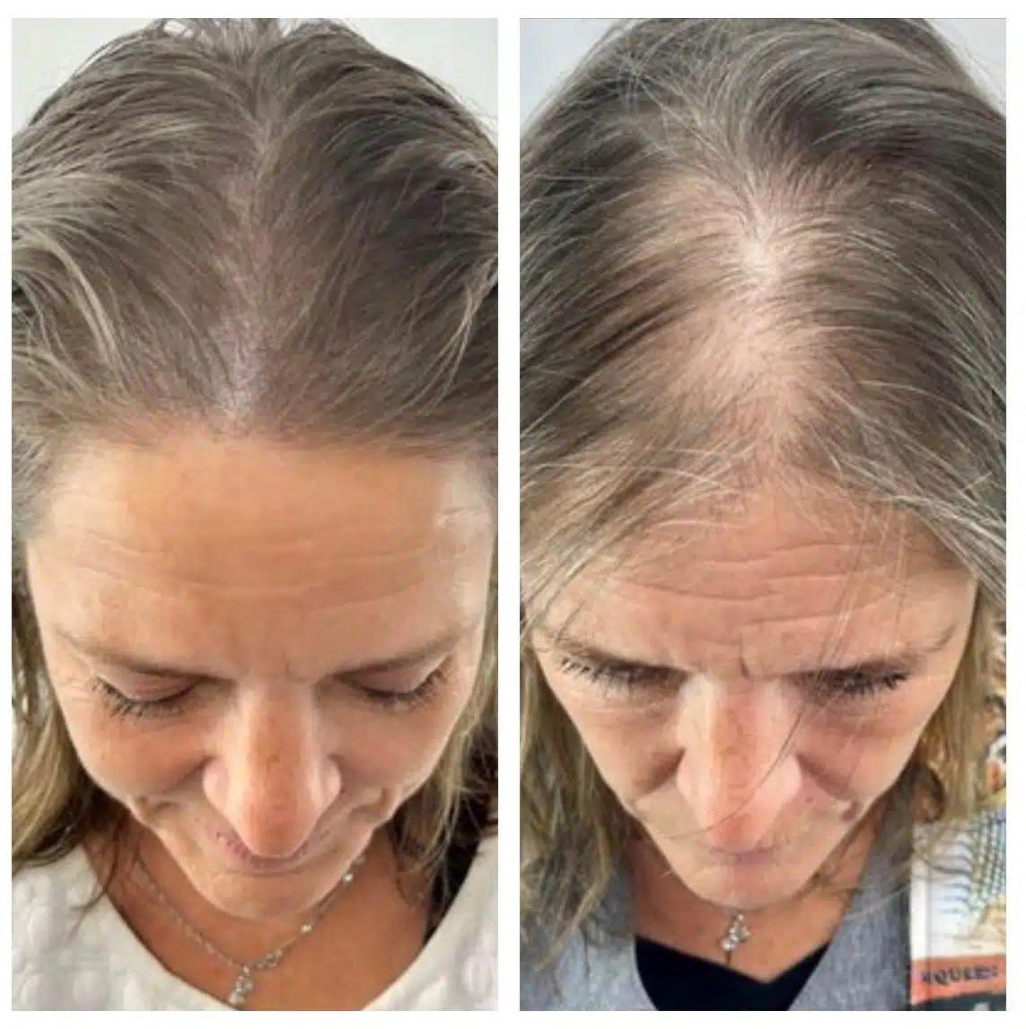 BENEFITS OF FEMALE SCALP MICROPIGMENTATION by Natural Scalp Issuu