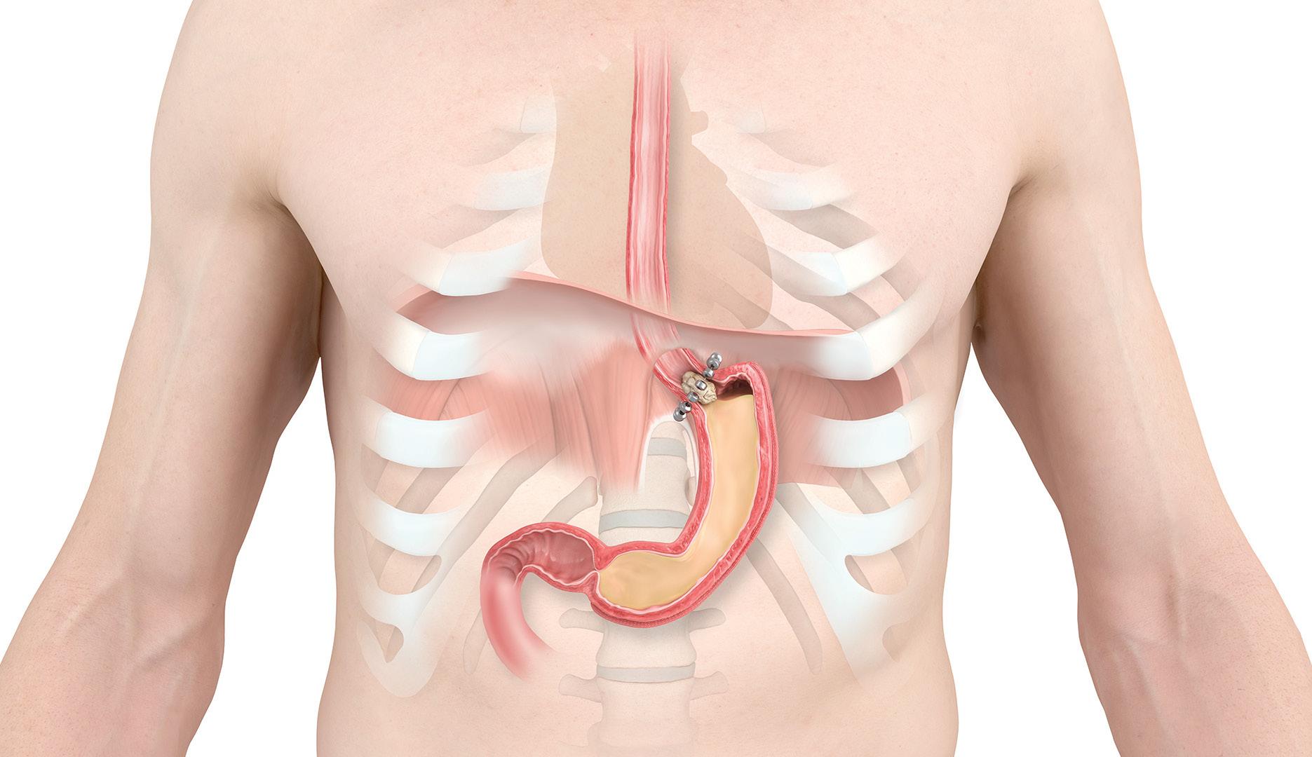 GASTROESOPHAGEAL REFLUX DISEASE (GERD) - BIMS Hospital