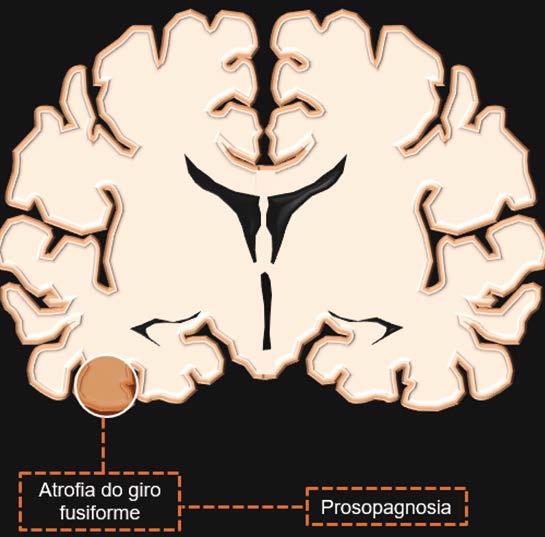 Distúrbios visuais e oculares: correlação topográfica de alterações intracranianas