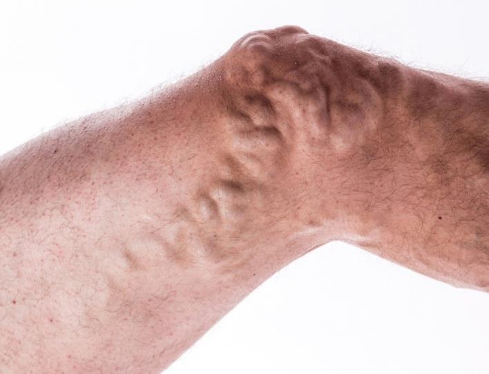 What Does The Vein Stripping Explain? by irvinkelley Issuu