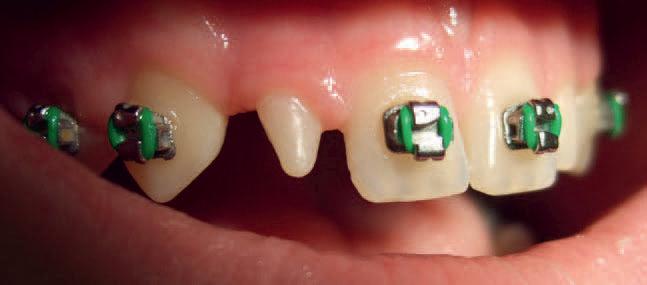 Triangle Elastics for Braces  Not Just Orthodontic Torture