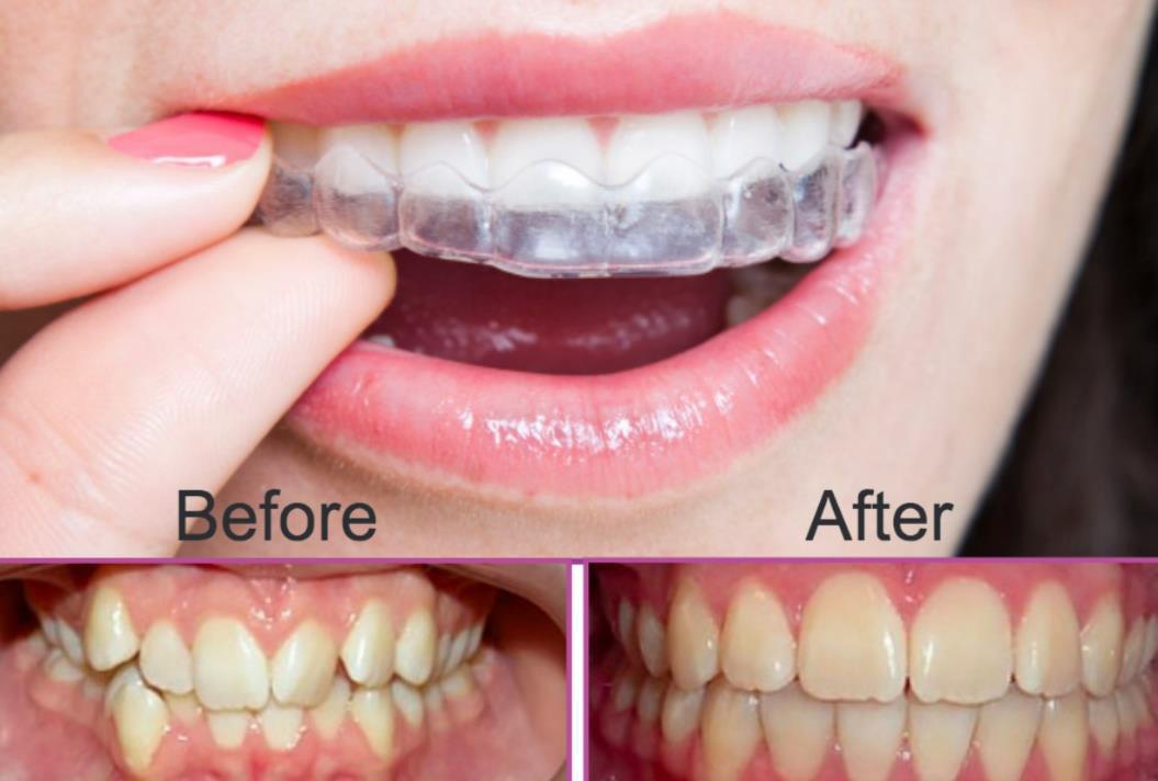 Clear Braces Sydney How Does Invisalign Work? by