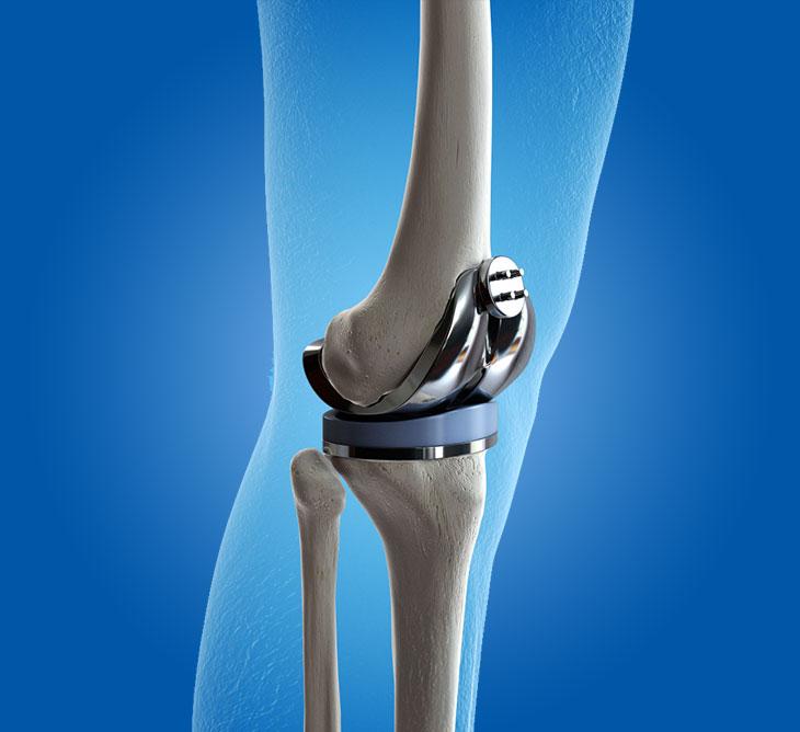Best Knee Replacement Surgeon in Hyderabad Ortho 360 by Ortho 360 Issuu