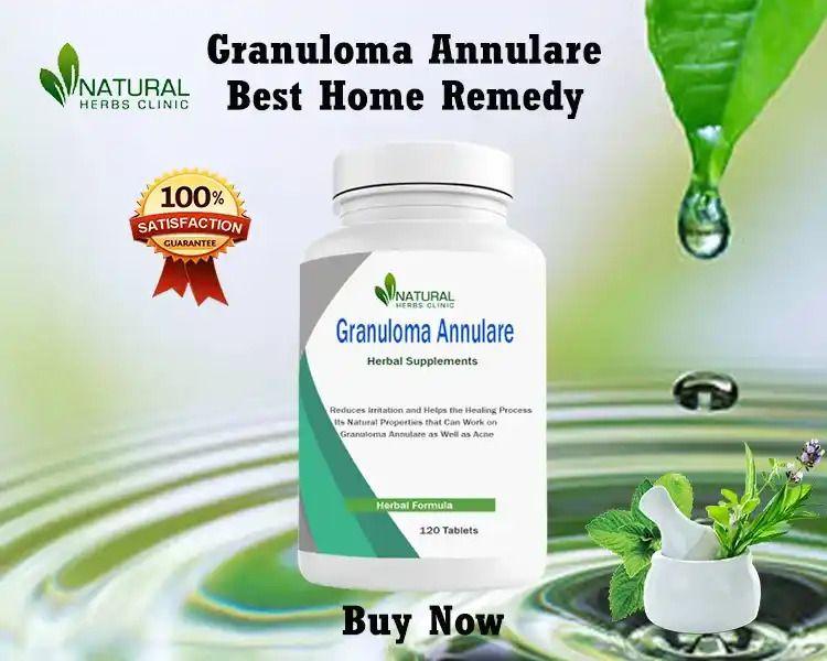 How to Get Granuloma Annulare Treatment at Home Safe Solutions for Home Use by Emma Milly Issuu