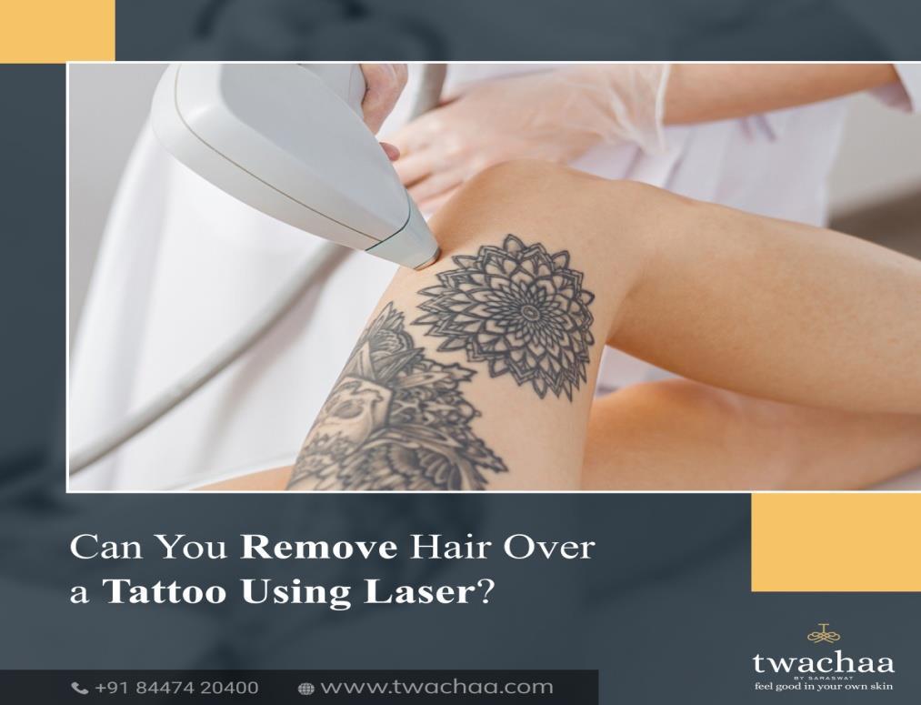 Top more than 69 laser hair removal over tattoo