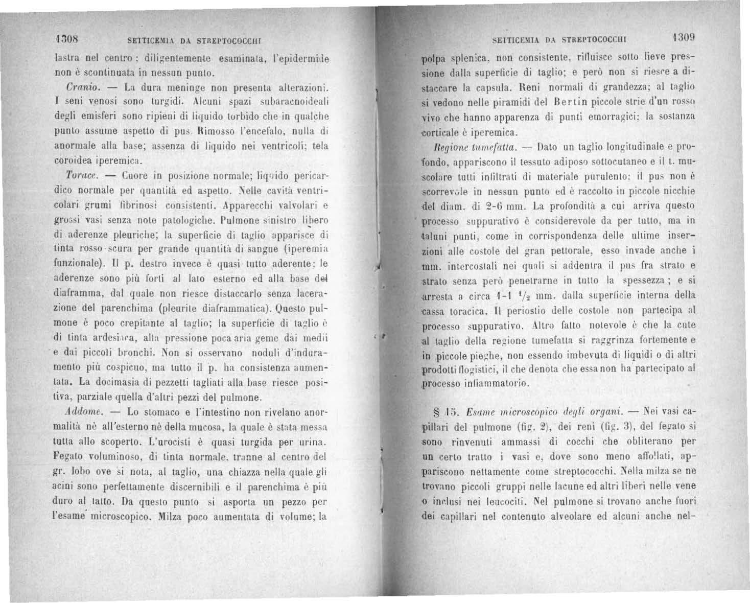 IJ ido pericardico normale per quantità ed aspello. cavilil ventricoluri grumi Apparecchi valvolan o gro .•si vasi senza note patologiclle. l'ulm one sinistro lipero di aderenze pleuriche; la superficie di taglio uppan:.ce di tinta rosso scura per grande quantilit di sangue (iperemia funzio nale). TI p. destr·o invece è quasi lutto aderente: le aderenze sono più forti al Ialo esterno ed alla base rl!M diaframma, dal quale non ri esce distaccarlo senza lacerazione del parenchima (pleurite diaframmatica). l)ueslo pulmoue è poco crepita nte al tnglio; la supe rOci e di ta;1lio è di tinta arcle:;i 1ra, alla pressione poca aria geme dai medti e dai piccoli bronchi. si noduli d'induramento più co.;picuo. ma Lutto il p. ha consistenza aumentata . La docimasia ùi pezzetli 1agliati alla hase riesce positiva, parziale quella d'altri pezzi del pulmone. .tcldomt. - Lo stomaco e l'intestino non rivelano anor· malitil nè all'esterno nè della mucosa, la quale è messa tulla allo scoperto. L' urocisti è quasi tnrgida per urina. Fegato volum inoso, di tinta normal e. tr.1nne al centro rlel gr. lobo ove si nola, al taglio, una chiazza nella quale gli acini sono perfettamente discer·nihili e il parenchima è piir dnro al tallo. Da questo punto f' i asporta nn pezzo per microscopico. poco aumeutala di Yolnme; la polpa non consistente. rilluiscc so 1lo lieve pressione dalla superficie di tagl io; e però non si a distaccare la capsula. l{eni normali di grandezza; al taglio si vedono nell e piramidi cl el Berti n piccole strie d' un , .ivo che hanno apparenza eli punti emorragici: la sosta nza -corticale è ipcremica. ttegione tl(mr(atla. - flato un Laglio longitudinale e profondo, appariscono il adiposo sollocutanr.o e il l. musco lare tuili inlillrati di materiale put·ulento: il pus non è in nessun punto td è raccolto iu piccole nicchie del diam. di 2-(} mm. La profonditit a cui arriva que:;to suppU!·ativo <; da per tuuo, ma in tnlunt punti, come in corrispondenza delle ultime inserzioni alle costole del gran peuorale. esso invade anche i mm. intcrcostali noi qun li si adde nu·a il pus fra strato e strato senza però penetrarne rn tnllo la ; e si an·estll a circa 1- 1 1/: mm. dalla supe rli cie interna della -cassa toracica. Il periostio delle costole non partecipa al p1·or.e:;:;o :; uppurativo. Altro fatto noLel'ole i• che la ente al della wmefatta si rn!!grinta fortemente e in piccole pieghe, non essendo imbe1·uta di liquidi o di :litri prodotti no;.dstici, il che denota che es;;a non ha partecipato al ,proc esso inli a mmat orio.
§ l ;;. Esame microscO!Iico dr!Jli organi. - vasi capill ari del pulmone (fi:,r. '2 ), dei reni 3). del fepato si so no rinven uti ammassi di cocch i che obliterano per un certo trnllo i vasi c, dove sono meno a!To!lati, appari scouo nellamenlc come strep tococchi. milza SP ne trovano piccoli gruppi nelle lacune ed altri liheri nelle vene o inr.lusi nei Nel pulmone si trovano anche fuo1·i dei capillari nel contenuto all'colare ed alcuni anche nel-
![