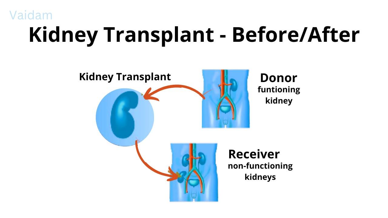 Kidney Transplant Cost in India by Tushar Sharma Issuu