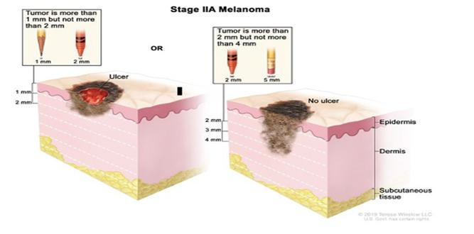 Options for Stage II Melanoma Cancer: Making the Decision That's Right ...