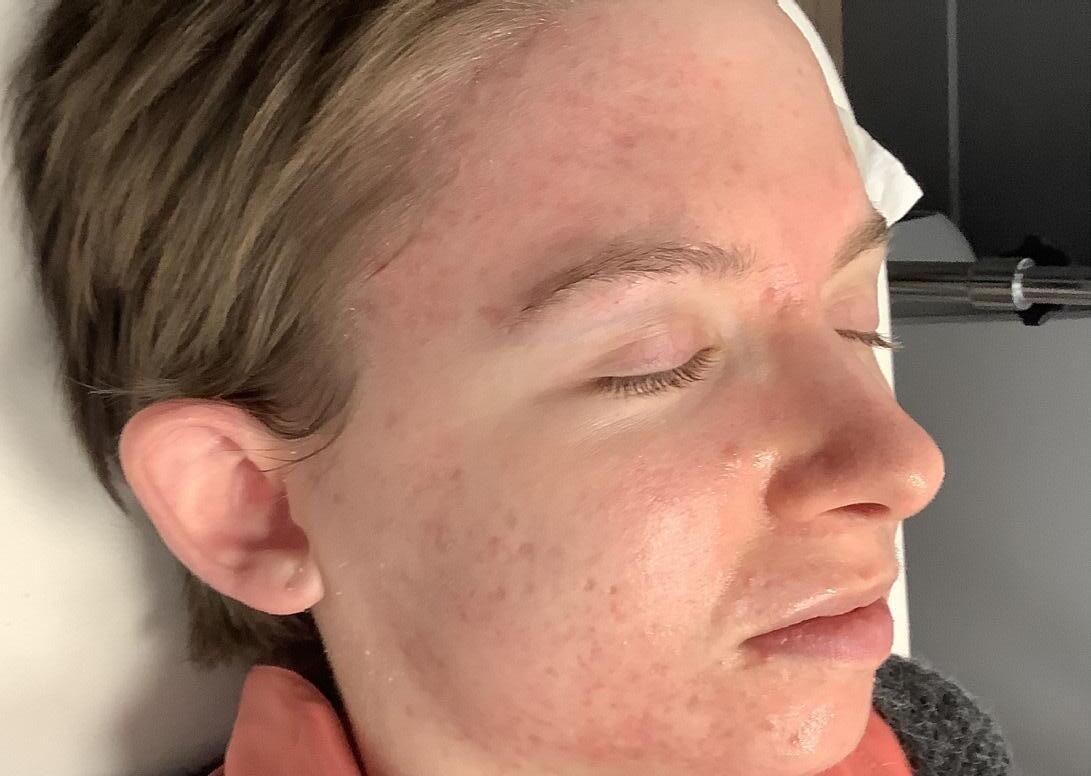 LaserAway Services Lookbook by LaserAway Issuu