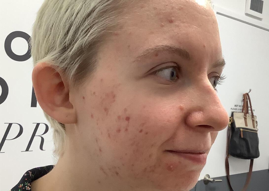 LaserAway Services Lookbook by LaserAway Issuu