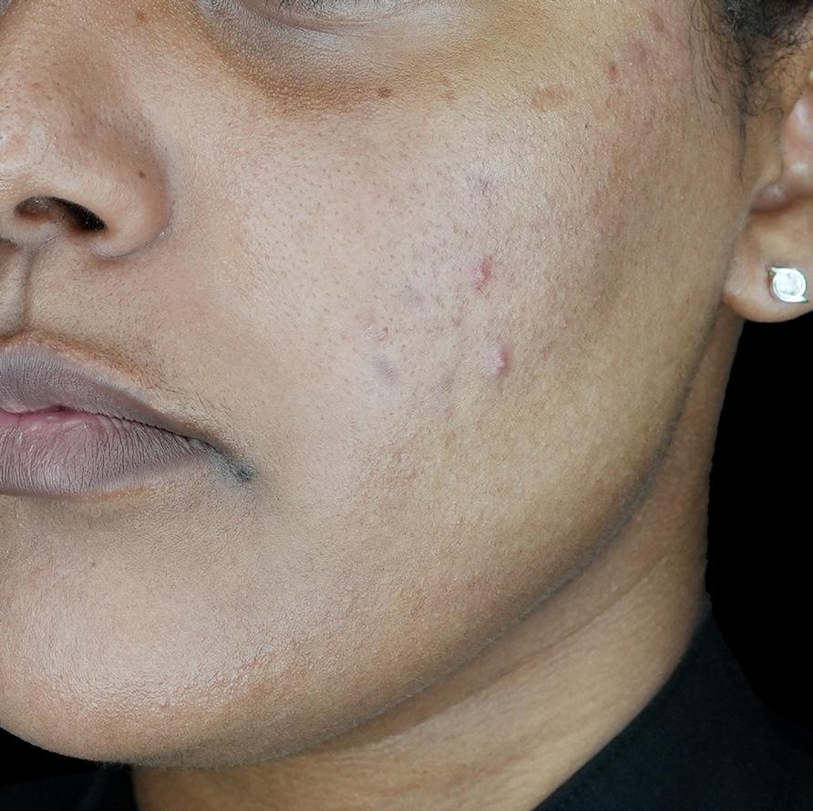 LaserAway Services Lookbook by LaserAway Issuu