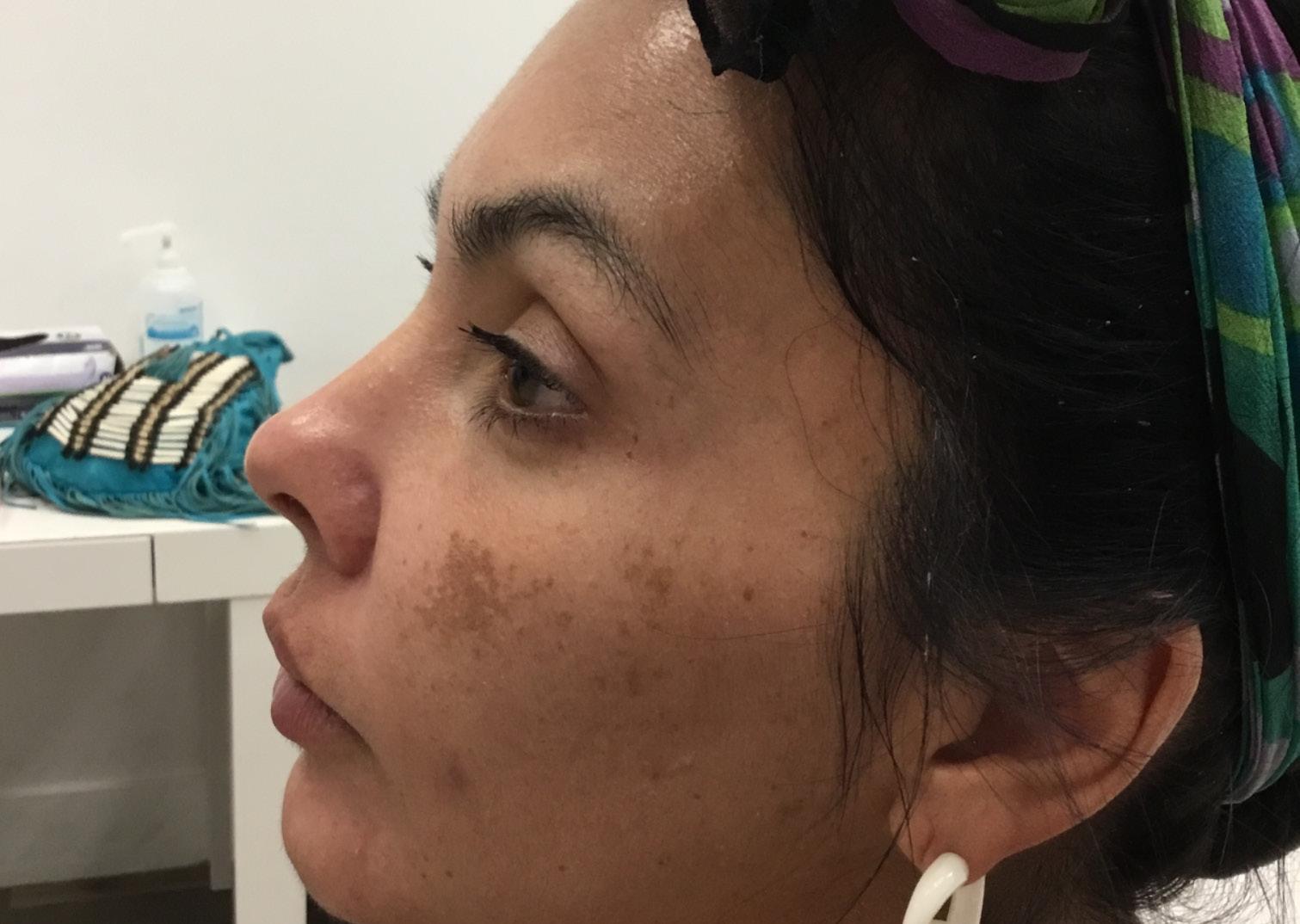 LaserAway Services Lookbook by LaserAway Issuu