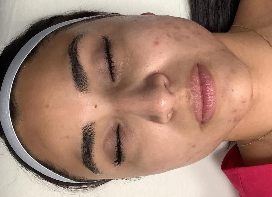 LaserAway Services Lookbook by LaserAway Issuu