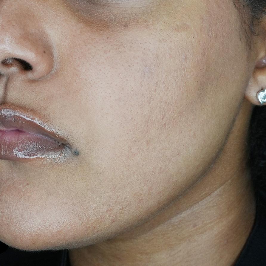 LaserAway Services Lookbook by LaserAway Issuu