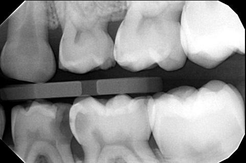 Successful Treatment of a ‘Pedo-Endo’ Lesion in a Primary First Molar