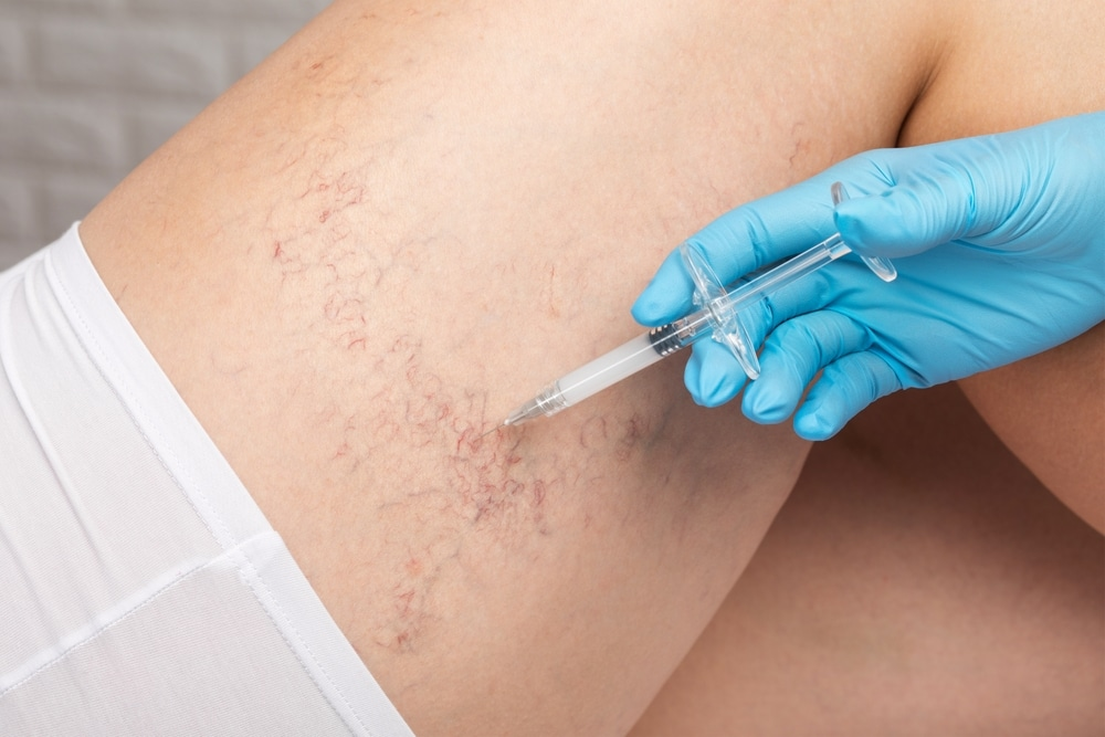 Cover for What Physiological Changes Occur During Varicose Veins Treatment?