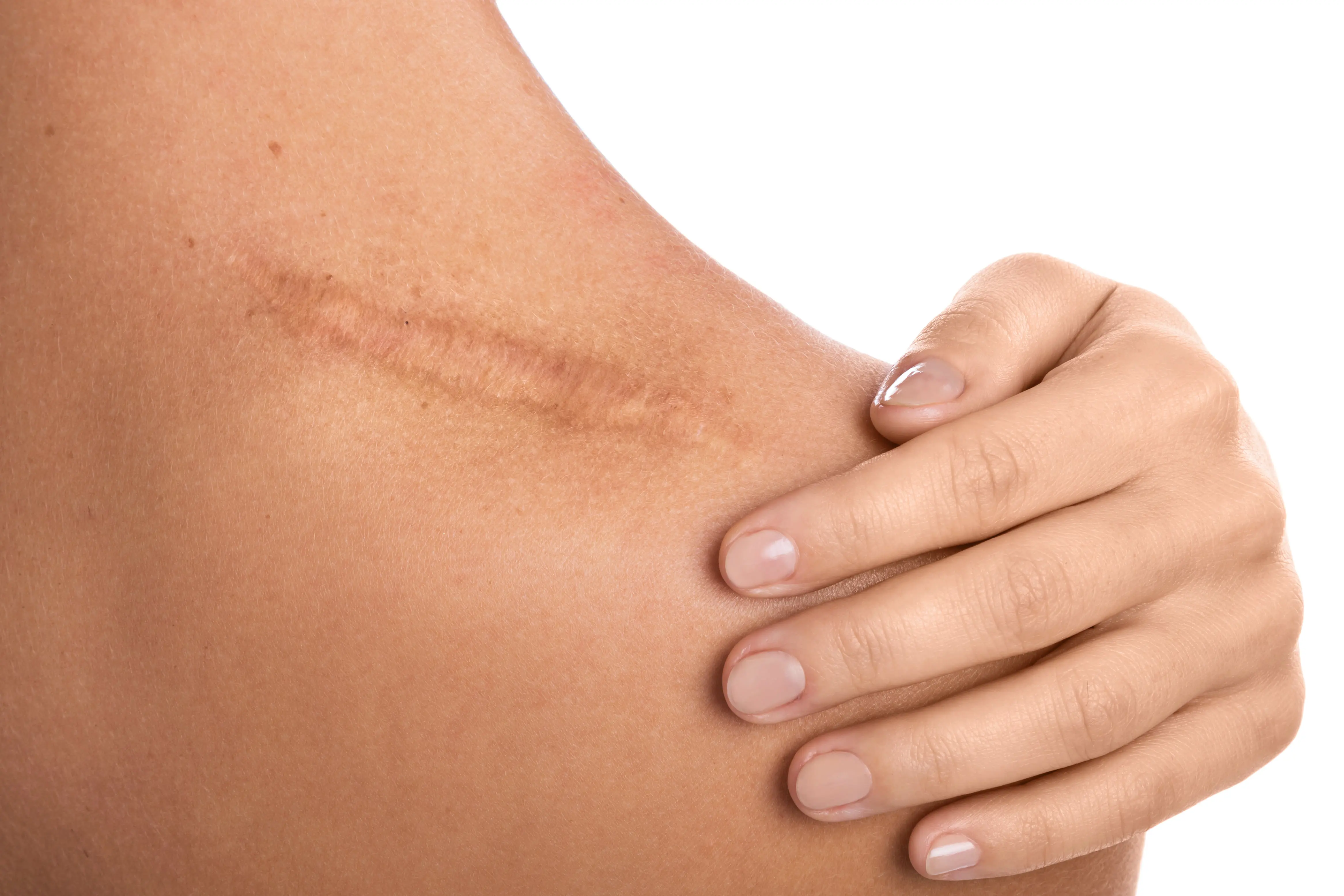 Cover for What Are the Goals of Hypertrophic Scars Treatment?